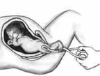 Partial Birth Abortion Step 1