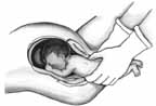 Partial Birth Abortion Step 2