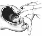 Partial Birth Abortion Step 3